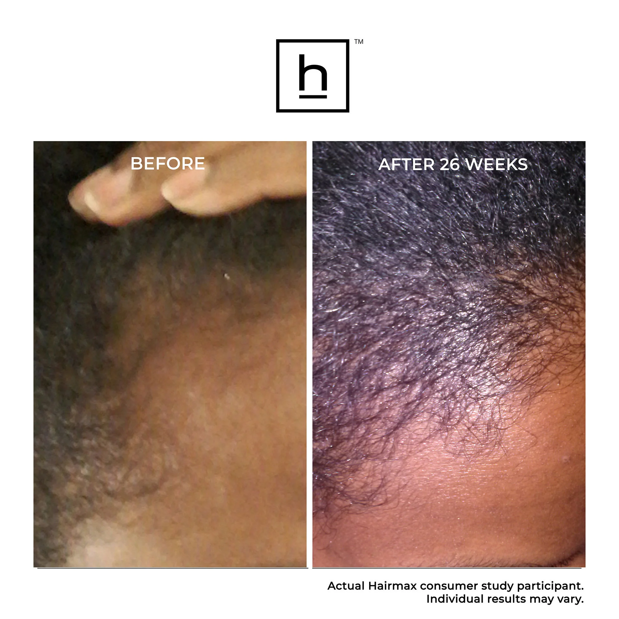 Ultima 12 Hair Growth LaserComb - Image 4