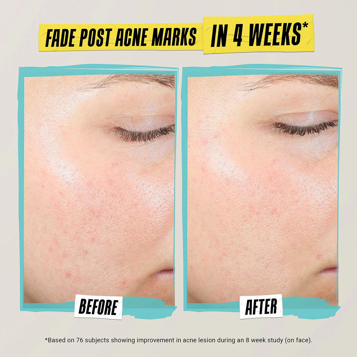 Expertly Clear Acne-Treating & Preventing Lotion - Image 4