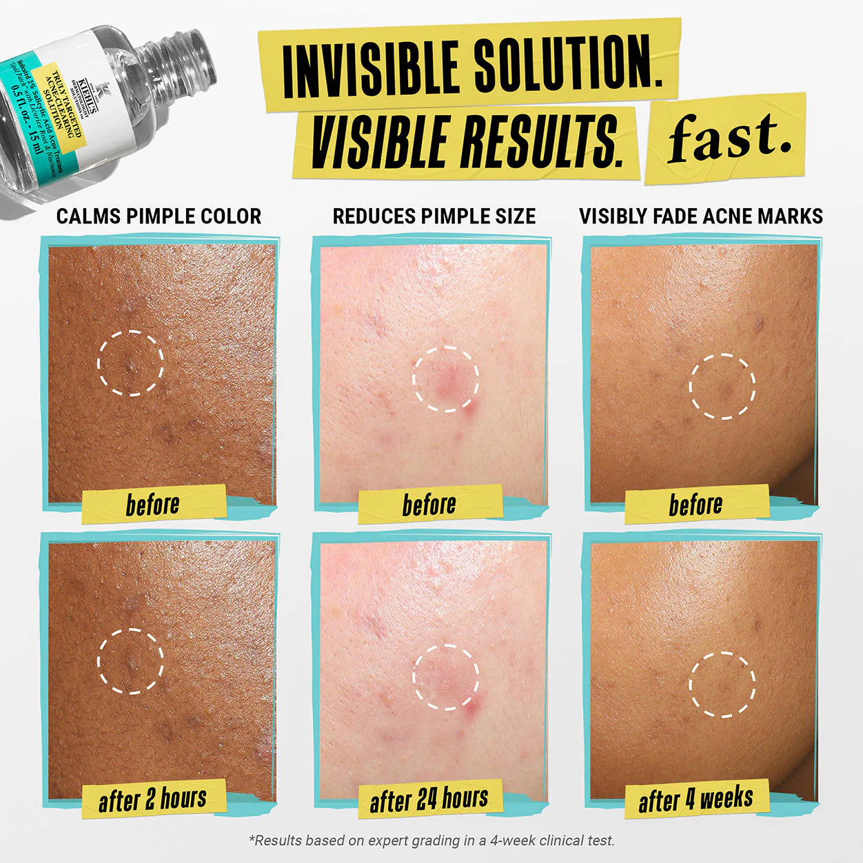 Truly Targeted Acne-Clearing Solution - Image 3