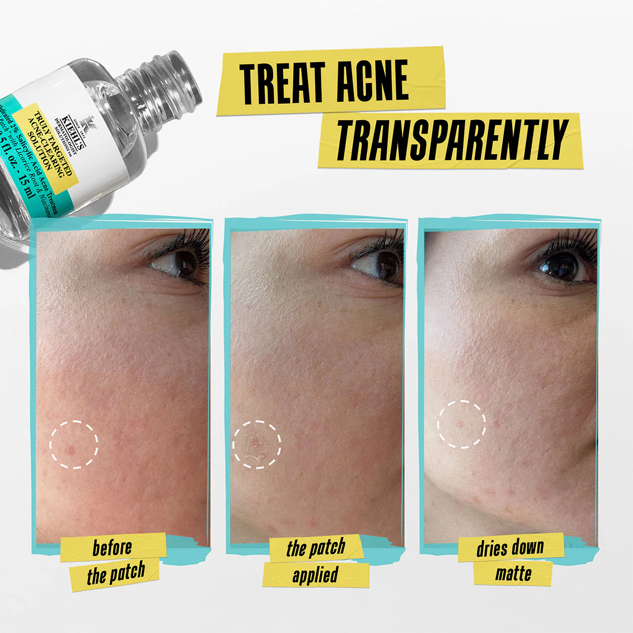 Truly Targeted Acne-Clearing Solution - Image 4