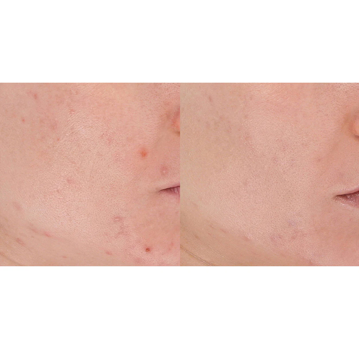 LightStim for Acne - Image 5