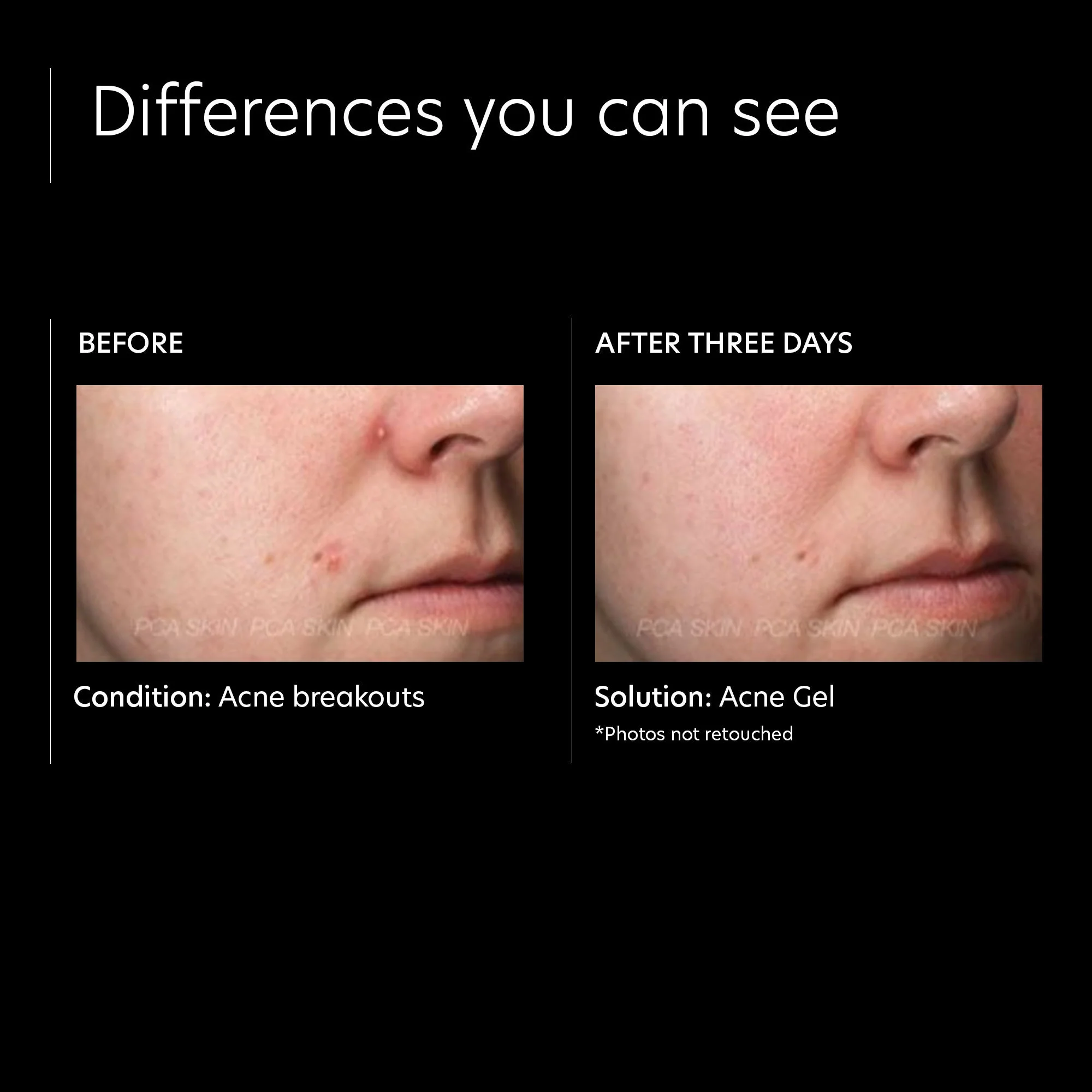 Acne Gel With OmniSome - Image 8