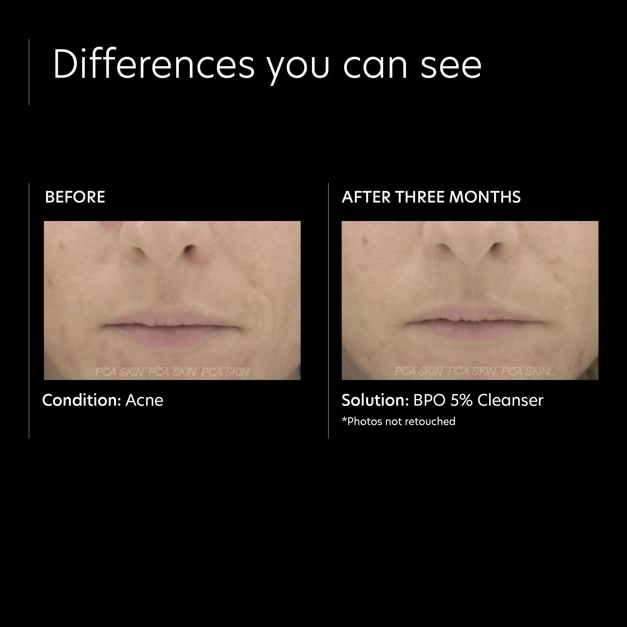 BPO 5% Cleanser - Image 5