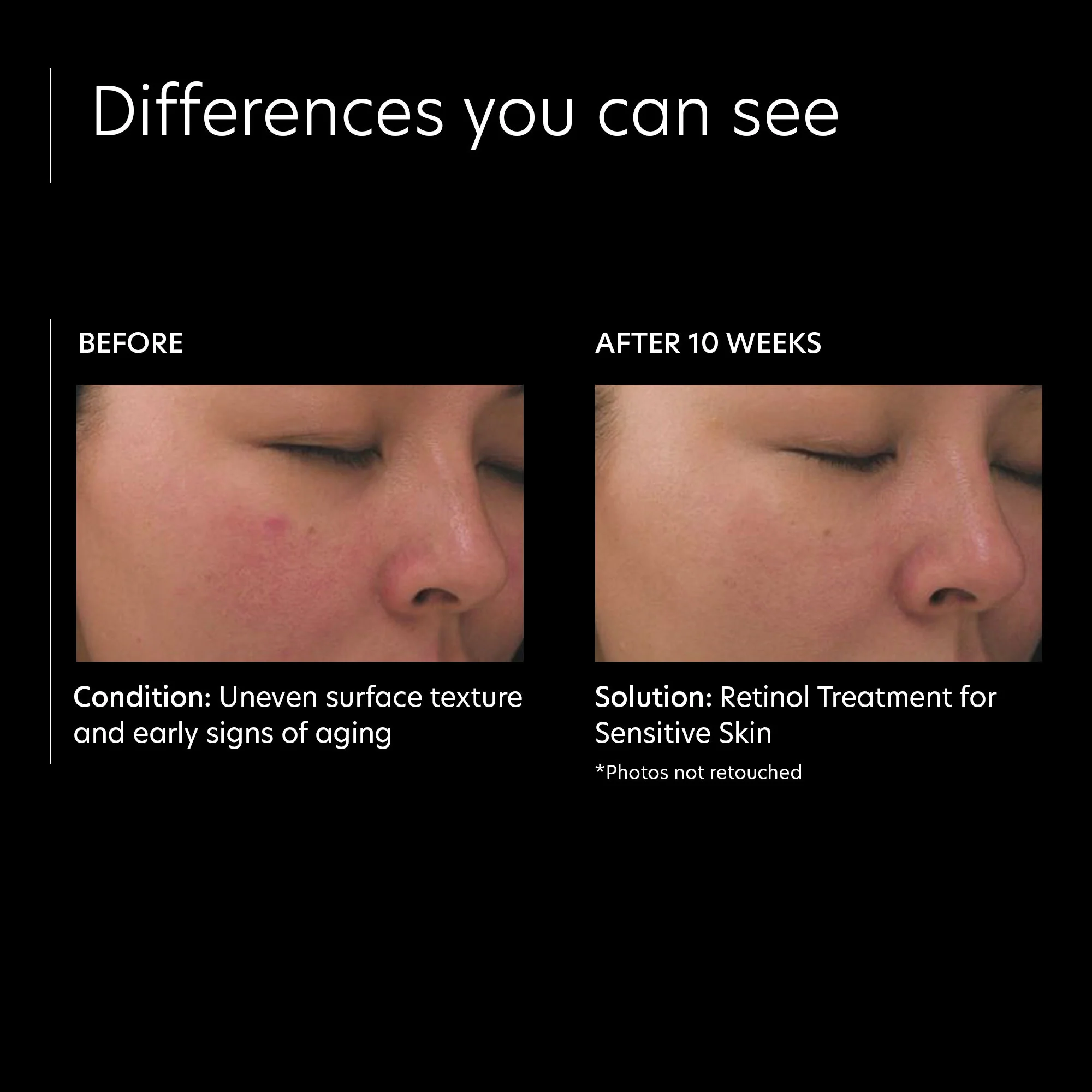 Retinol Treatment for Sensitive Skin - Image 3