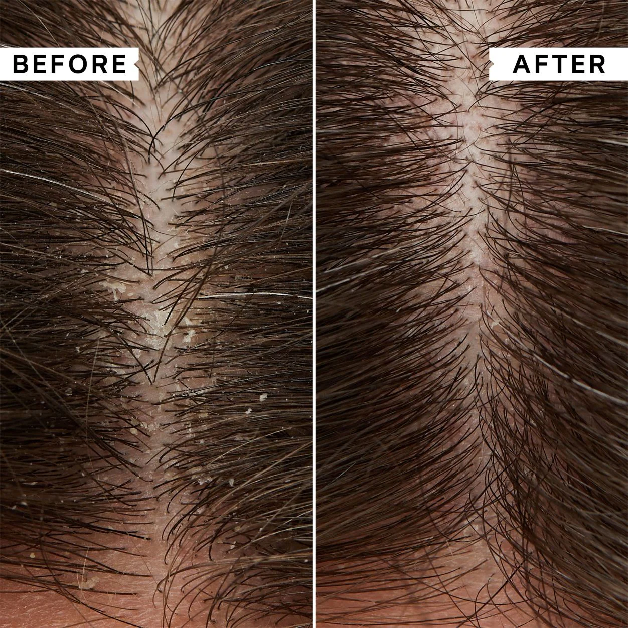Flaky Scalp Exfoliating Mask - Image 3