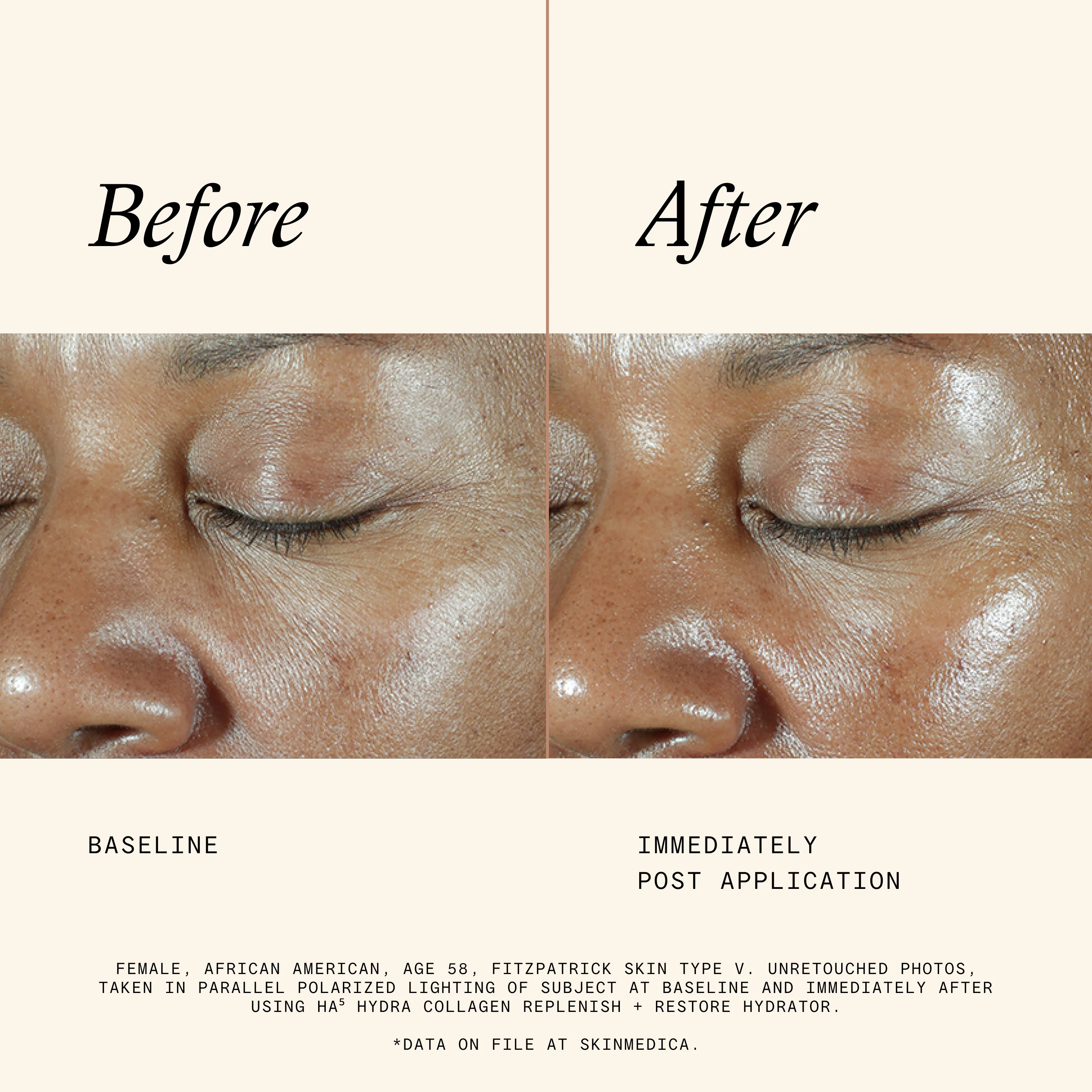 Post Micro-Needling + Injection Bundle - Image 3